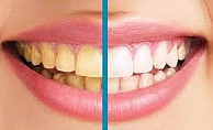 Dişlerinizin Sararmasına Doğal Çözüm
